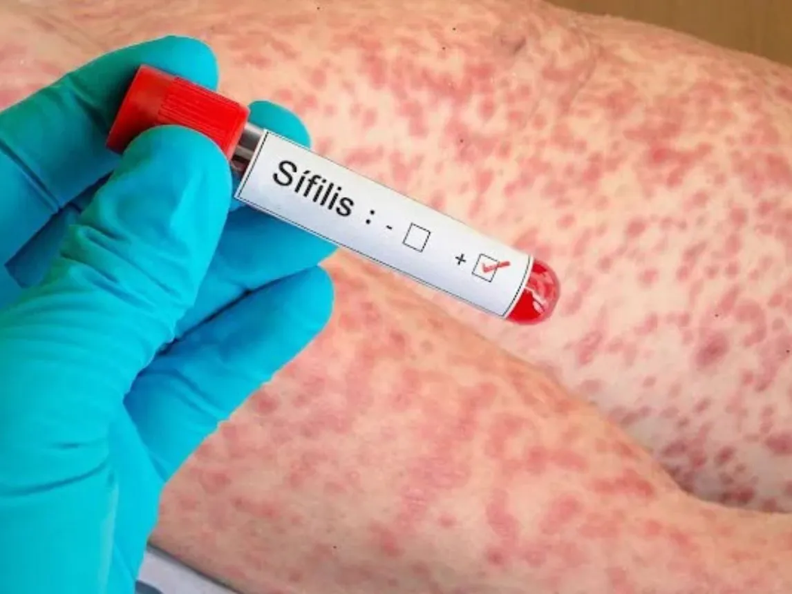 sifilis-1146x860